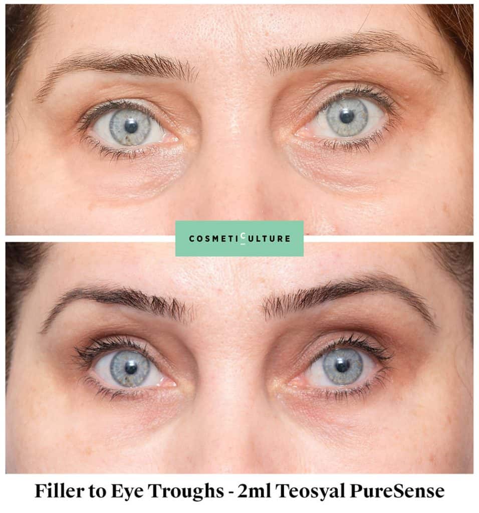 How Long Does It Take For Filler To Settle Under Eyes